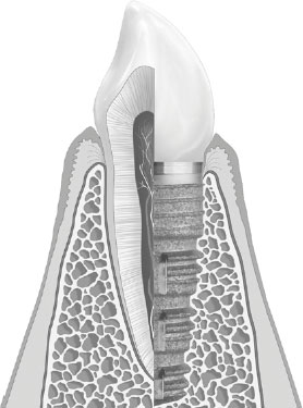 Zahnersatz-Querschnitt